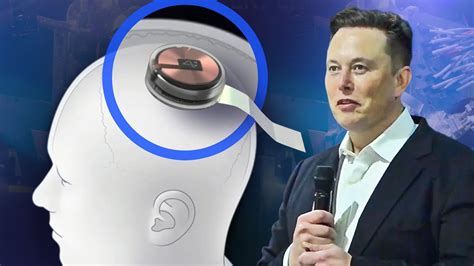 rfid chip brain implant|Elon Musk's Neuralink Has Implanted Its First Chip in a .